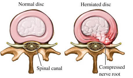 Résultats de recherche d'images pour « herniated disc »