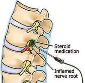 steriod injection