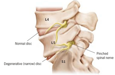 pinched nerve radiculopathy